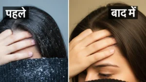 Dandruff